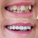 The Ultimate Battle of Invisalign vs Braces