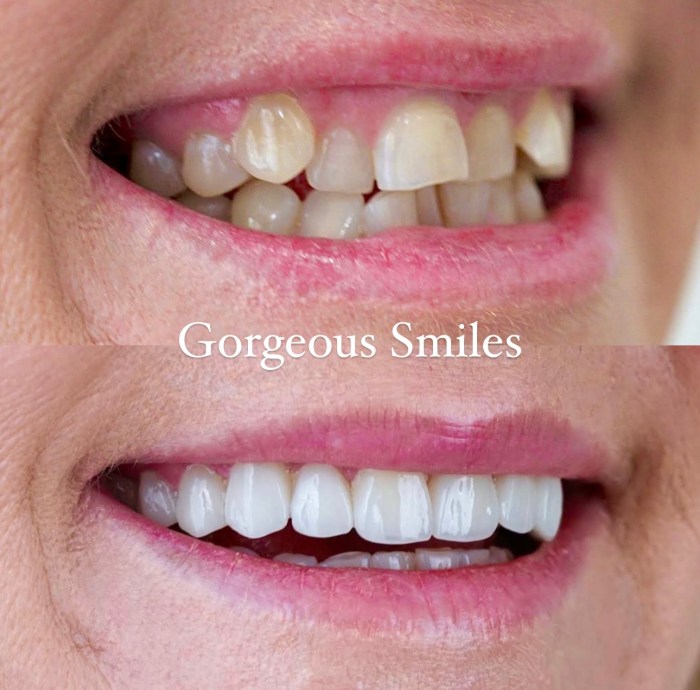 The Ultimate Battle of Invisalign vs Braces