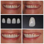Teeth Veneers Before And After