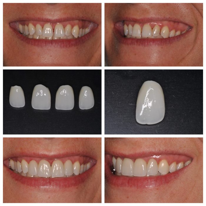 Teeth Veneers Before And After